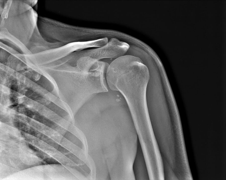 Röntgenbild einer Arthrose des Schultergelenks zweiten Schweregrades. 
