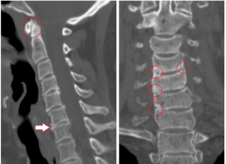 Die Computertomographie zeigt geschädigte Wirbel und Bandscheiben von heterogener Höhe aufgrund einer thorakalen Osteochondrose. 
