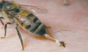 Behandlung von Hüftarthrose durch Bienen