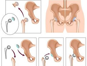 Endoprothesen bei Arthrose des Hüftgelenks